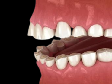 BRUXISMO - CIRUGIA MAXILOFACIAL EN BOGOTÁ