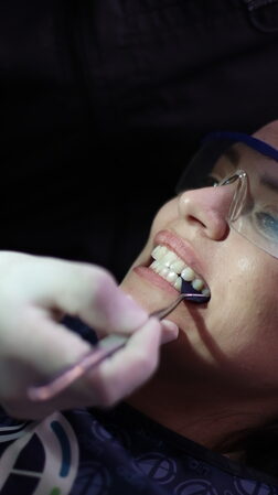 Bruxismo - Cirugía Maxilofacial en Bogotá