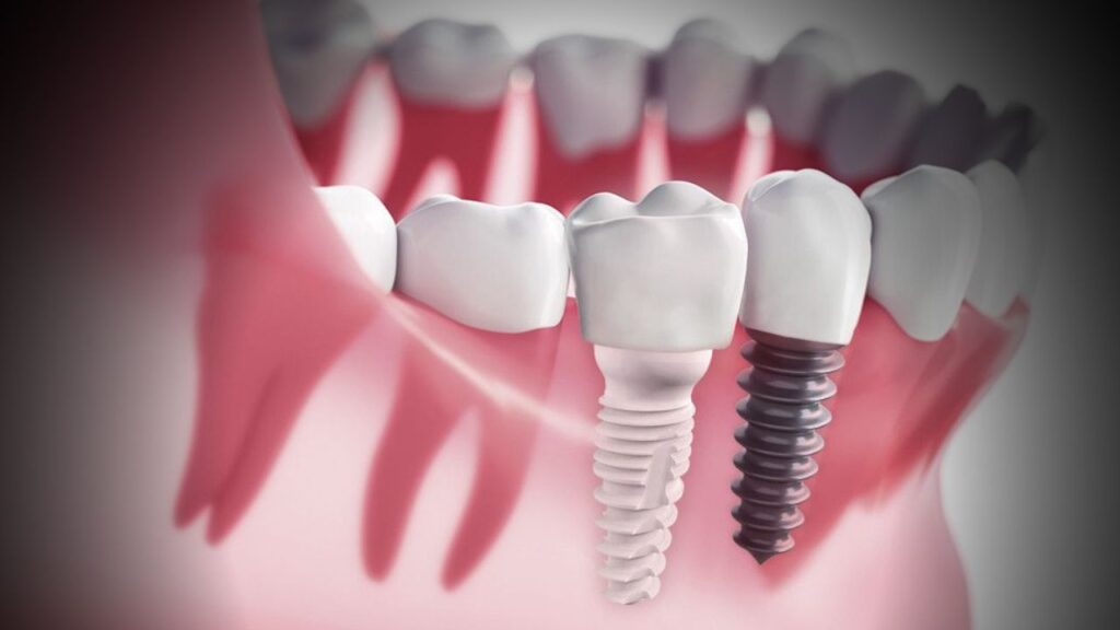 Titanium vs. Zirconia Implants: Which to Choose?