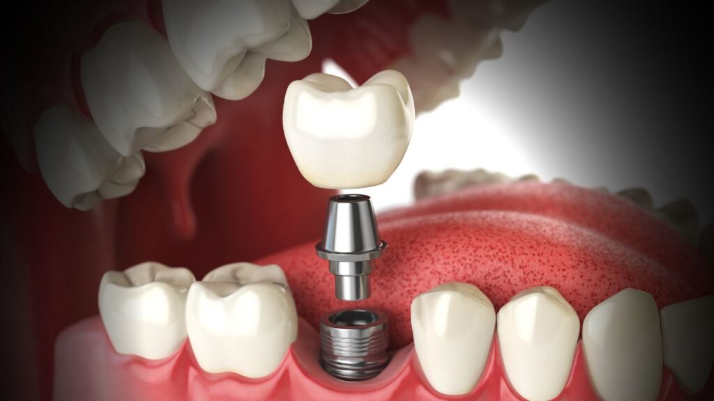 Proceso de Colocación de Implantes Dentales: Paso a Paso
