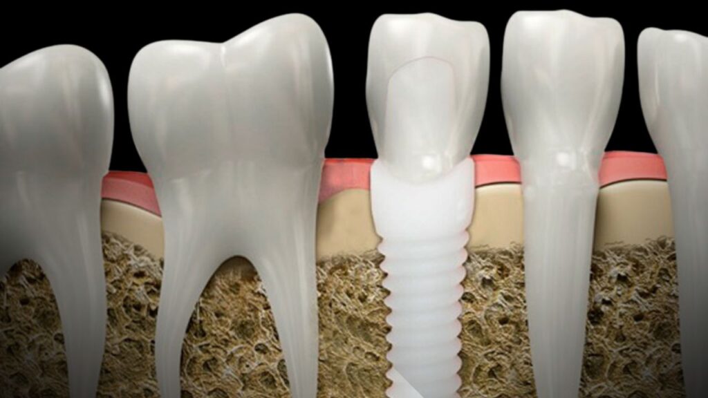 Materials Used Titanium vs Zirconia
