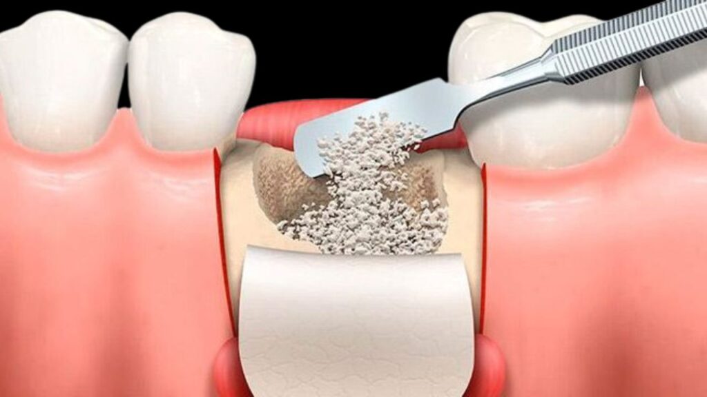 ¿Qué son los injertos óseos y cómo funcionan?