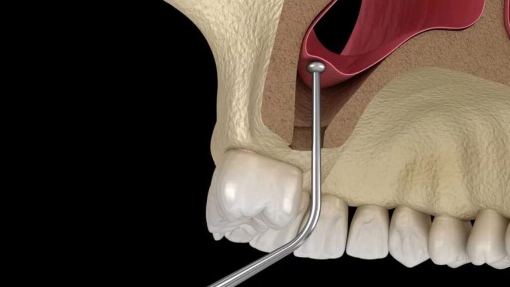 ¿Cúal es la diferencia entre un Injerto Óseo y la Elevación de seno maxilar?