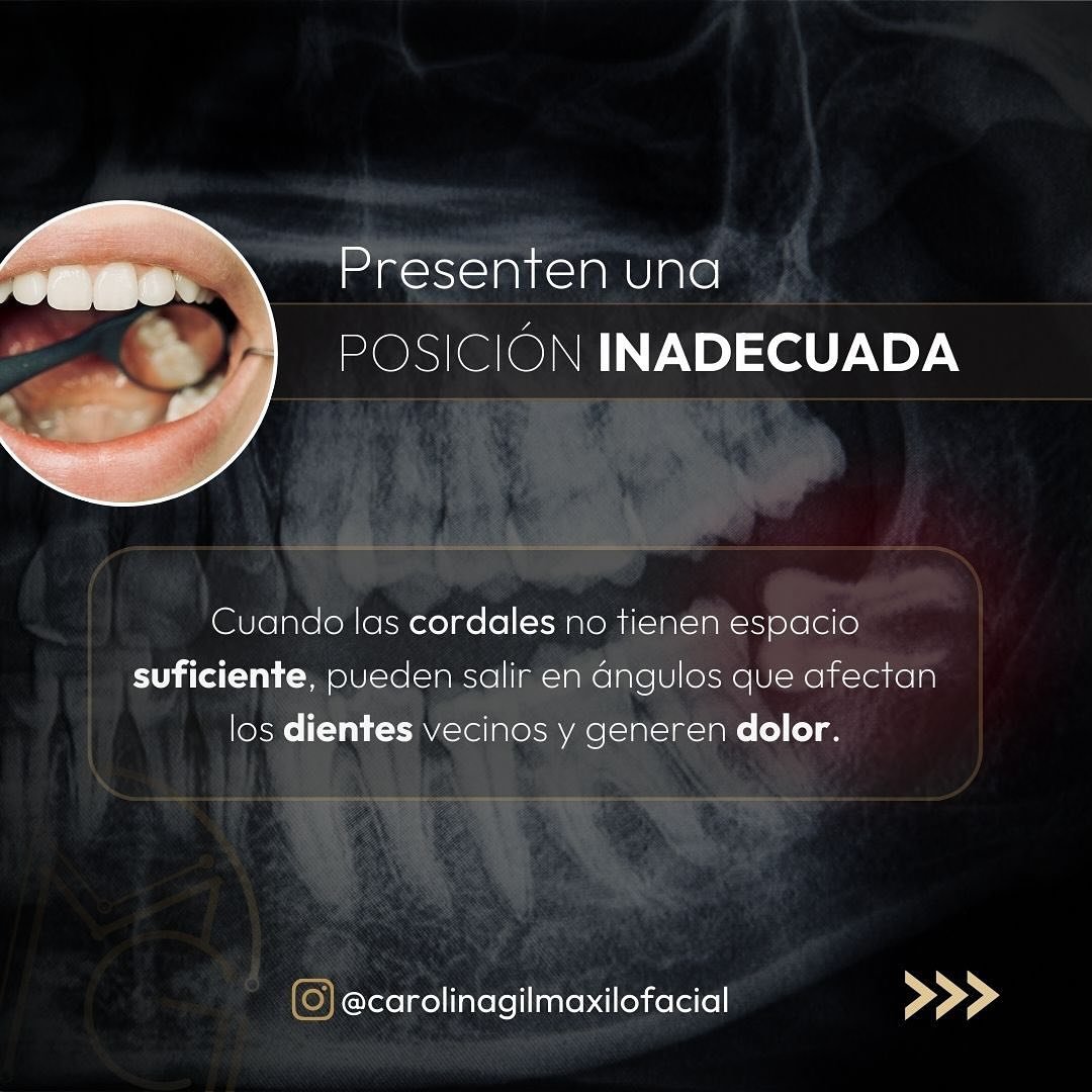 Extraccion de cordales 2