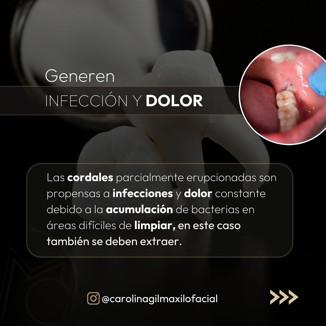 Extraccion de cordales 3