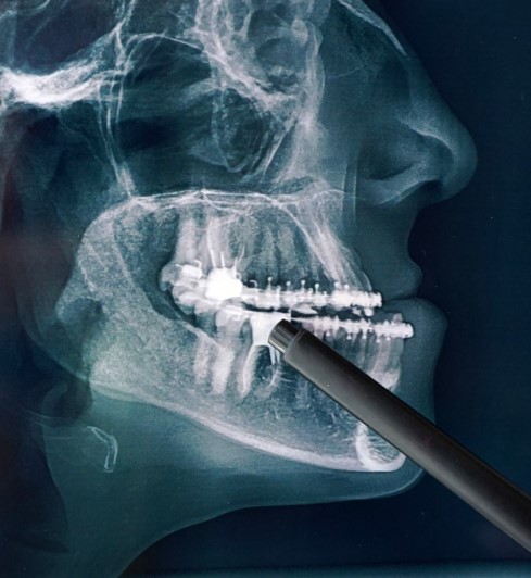Fracturas maxilofaciales