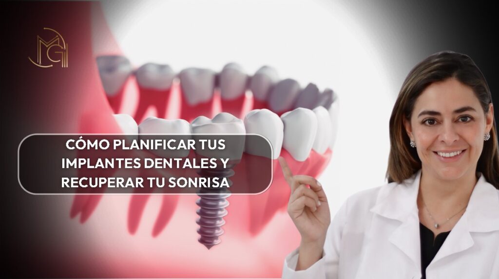 Cómo Planificar Tus Implantes Dentales y Recuperar Tu Sonrisa