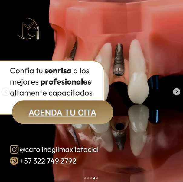 Implantes dentales en Bogotá