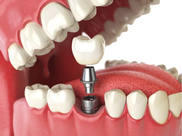 ¿Los implantes dentales duelen?