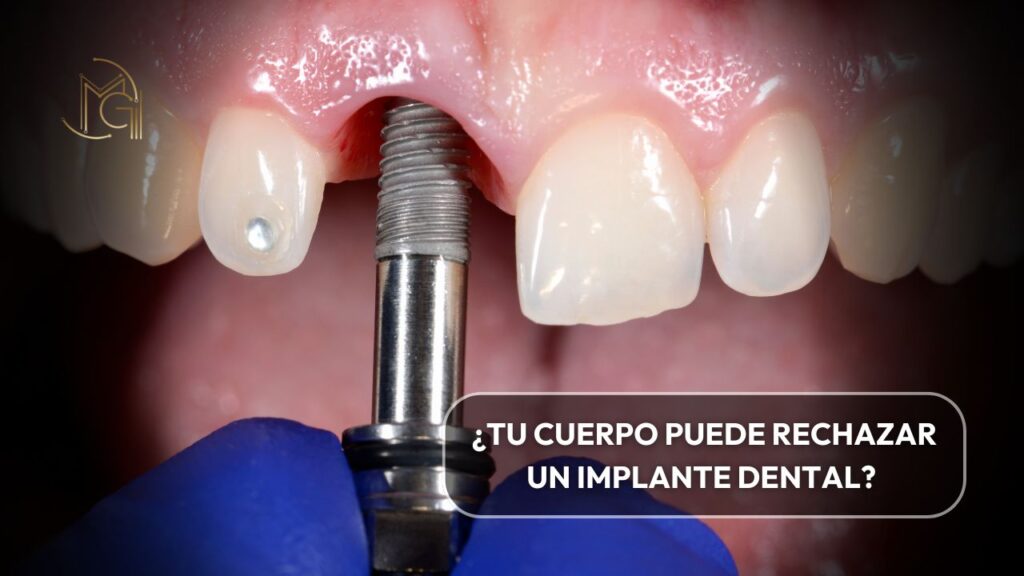 Implante dental rechazo