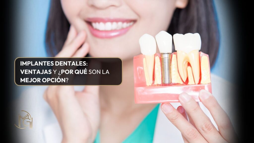 Implantes dentales ventajas