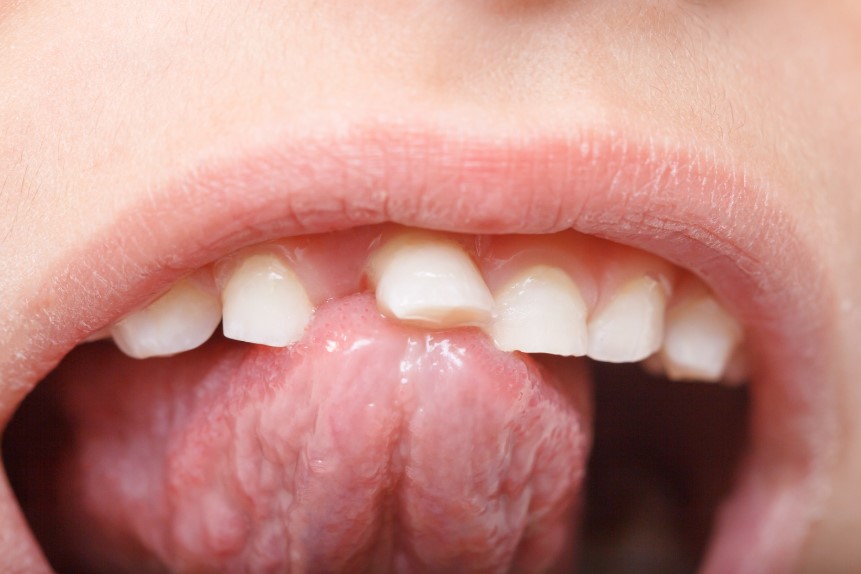 Qué hago si se me cae un diente