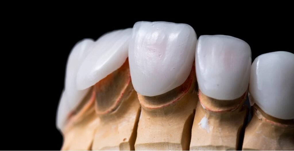 coronas dentales
