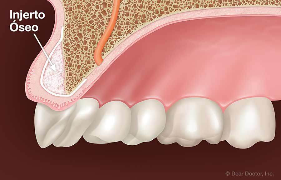 injerto óseo en Bogotá - Cirugía Maxilofacial en Bogotá - Dra. Carolina Gil