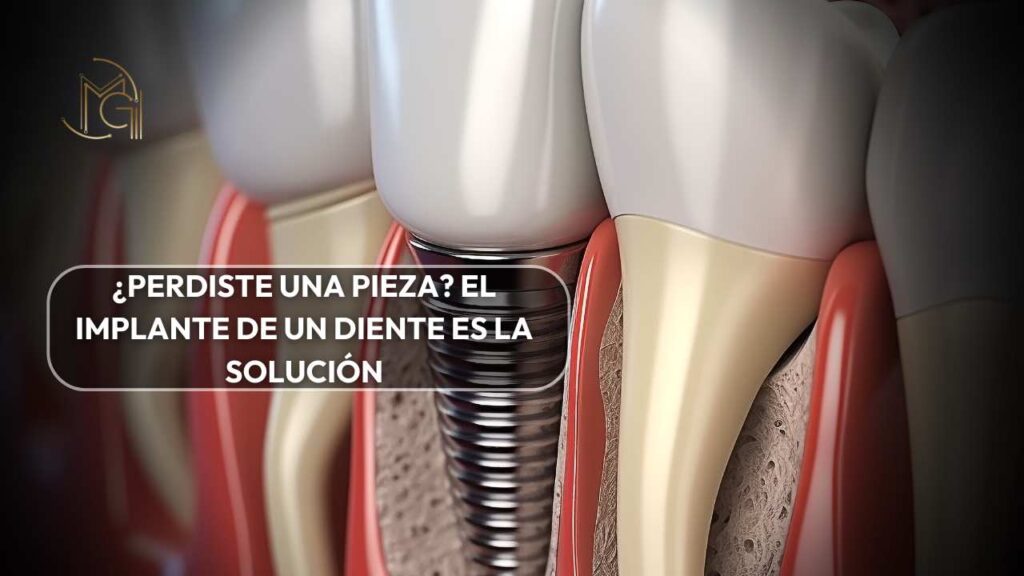 Implante de un diente en Bogotá con la Dra. Carolina Gil