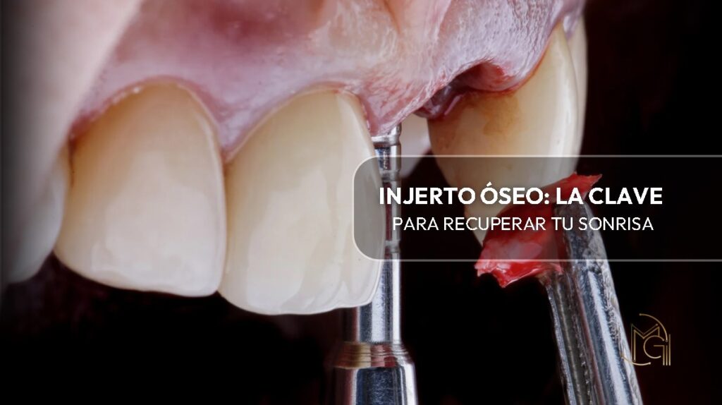 Injerto óseo- Dra. Carolina Gil