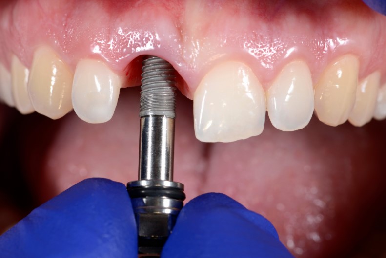 Odontóloga en bogotá poniendo un immplante de un diente