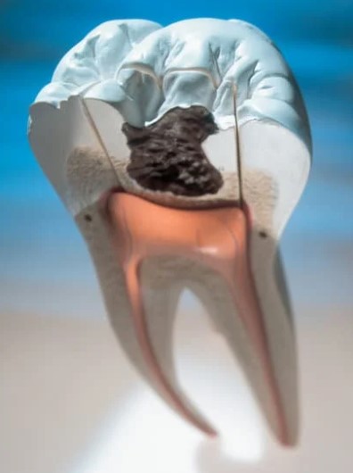 Qué es un tratamiento de conductos en Bogotá - Carolina Gil Maxilofacial en Colombia