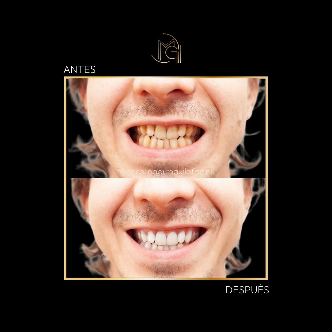 Diseño de sonrisa antes y después - Dra. Carolina Gil - Imagen de referencia - Bogotá, Colombia