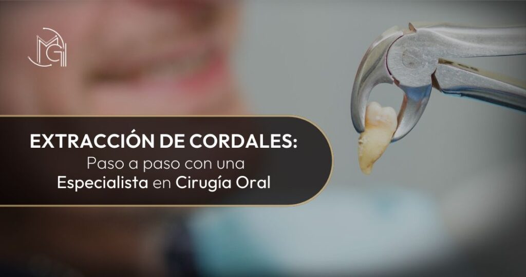 Extracción de cordales-Dra. Carolina Gil- Cirujana oral y maxilofacial