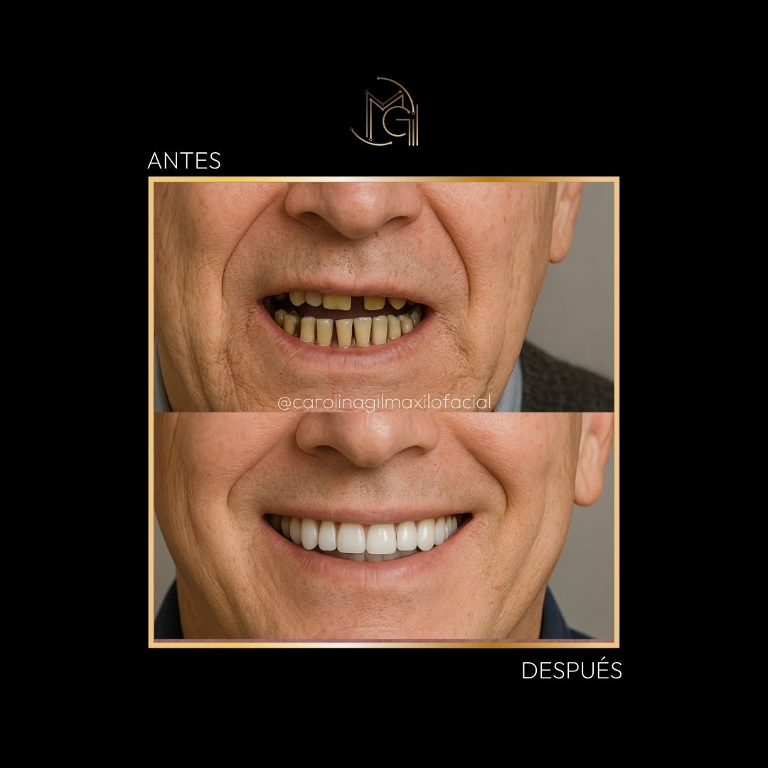 Implantes dentales antes y después - Dra. Carolina Gil - Imagen de referencia - Bogotá, Colombia
