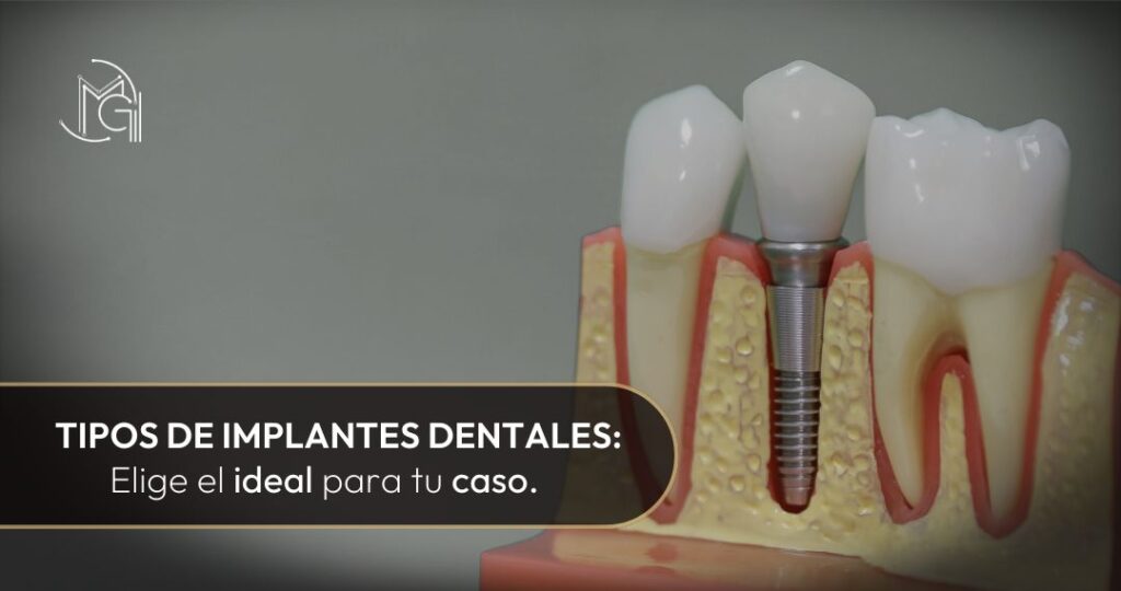 Tipos de implantes dentales-Dra. Carolina Gil