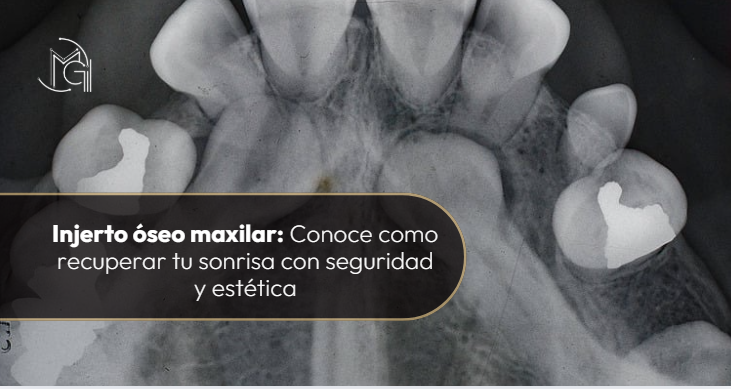 Injerto óseo Maxilar-Dra. Carolina Gil