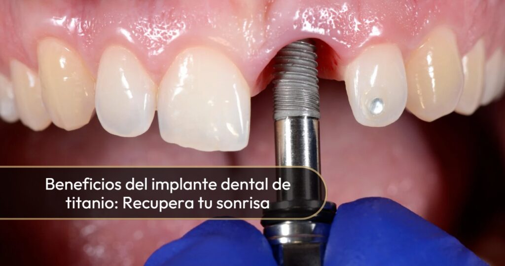 Beneficios implante dental de titaneo-Dra. Carolina Gil